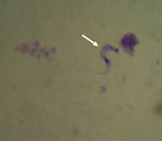 Thumbnail of Trypanosoma cruzi (arrow) in a peripheral blood smear of a patient at a local health facility in a rural area of Pará State, Brazil (Giemsa stain, magnification ×100). Image provided by Adriana A. Oliveira, Brazilian Field Epidemiology Training Program, Brasilia, Brazil.