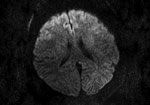 Thumbnail of Magnetic resonance imaging of the brain of a 55-year-old woman (patient 3) who had neurologic complications of influenza B virus infection, Romania. Axial diffusion-weighted image showing restricted diffusion in the bilateral frontal cortex.