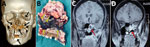 Radiographic images and surgical specimens demonstrating rhino-orbital-cerebral coronavirus disease–associated mucormycosis in patients from India, 2020. A) Three-dimensional reconstruction of computed tomography scan of 54-year-old male patient. Black arrows indicate patchy osteonecrosis involving the upper jaw, right orbital wall, and paranasal sinuses. B) Surgical specimen from the maxilla of 54-year-old male patient showing black necrotic paranasal sinus with palatal involvement indicated by yellow arrows. C, D) Magnetic resonance imaging (MRI) of coronal section of paranasal sinus and brain of 51-year-old female patient. Red arrow in panel C indicates enhancing cavernous sinus lesion; D) red arrow in panel D indicates right ethmoid and maxillary sinusitis. Scale bar indicates 7 cm. 